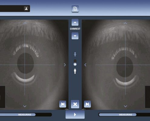 VX160 EyeRefract Diagnose