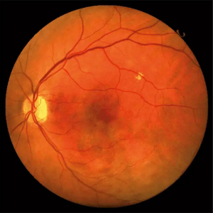 Retina (Trockene AMD)